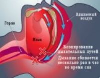 Как избавиться от храпа: простые упражнения